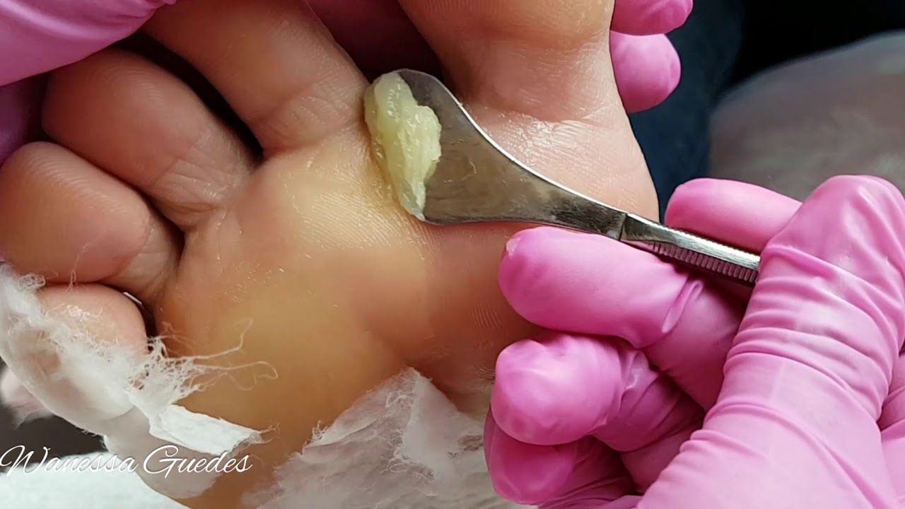 Curso de Plástica e Spá dos Pés - Remova Calos e Rachaduras